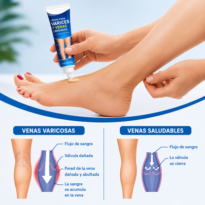 Crema varices